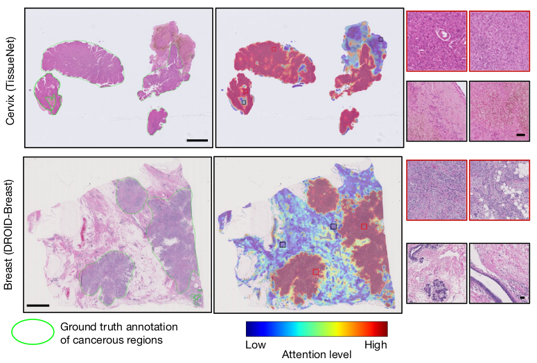 Revolutionizing Cancer Diagnosis with the CHIEF Foundation Model